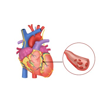 심장마비 주요 원인